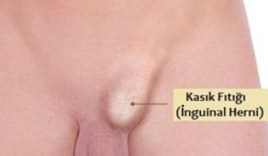 Fıtık örneği - kasık bölgesi (inguinal)