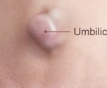Fıtık örneği - göbek (umbilikal)