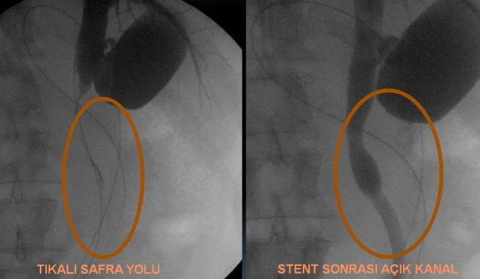 Safra yolu tıkanması - ERCP görüntüsü (örnek)