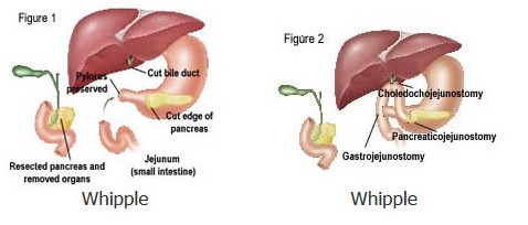 Whipple ameliyatı şeması / post-op